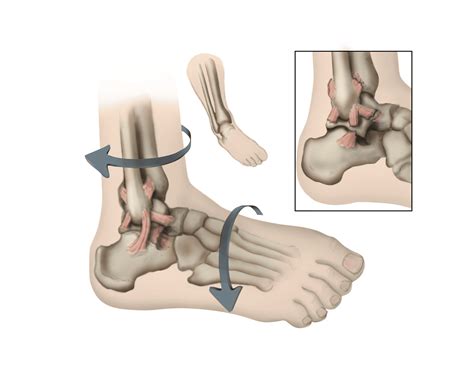 Ankle Sprain Grades