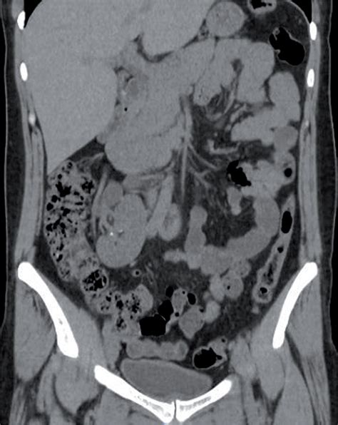 SciELO - Brasil - A rare case of supernumerary fused and malrotated ...