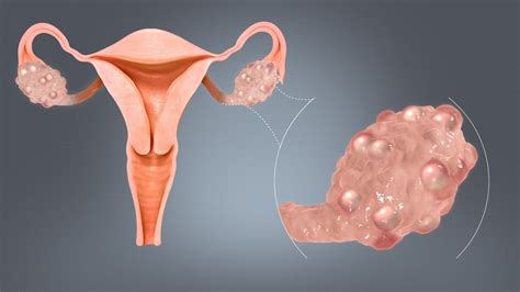 Polycystic Ovary Syndrome (PCOS): Signs, Symptoms, Causes, and ...