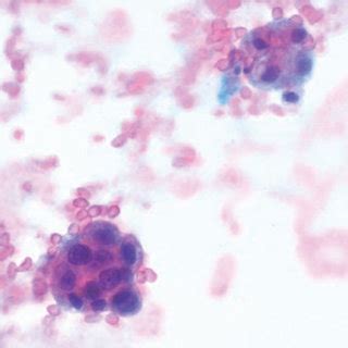 (a) Pleural and pericardial fluid cytology (10x) shows mesothelial ...