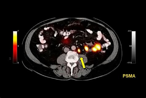 PSMA PET/CT beats standard scan at prostate cancer detecting ...