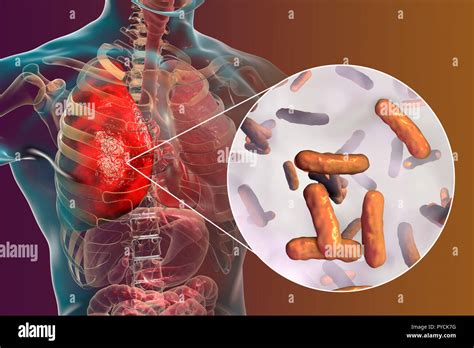 Pseudomonas infection hi-res stock photography and images - Alamy