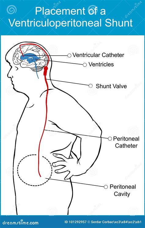 Placement of a Ventriculoperitoneal Shunt Stock Vector - Illustration of medical, ventricles ...