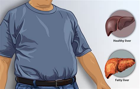 Beware! Even mild fatty liver disease may up death risk - OrissaPOST