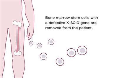 Gene therapy pioneered at St. Jude shows early success against "Bubble ...