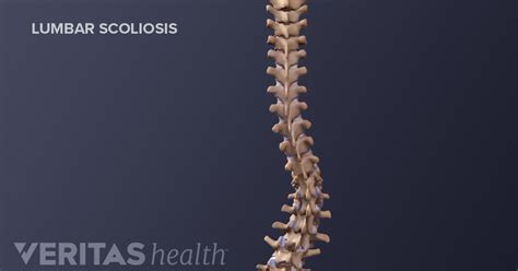 Degenerative Scoliosis Symptoms and Diagnosis