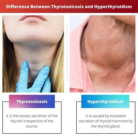 Tirotoksikosis vs Hipertiroidisme: Perbedaan dan Perbandingan