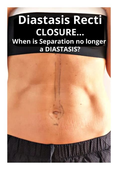 Diastasis Recti: CLOSURE…When Is Separation No Longer A DIASTASIS ...