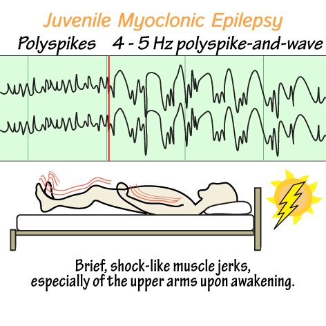 Neurological System Glossary: Juvenile Myoclonic Epilepsy (JME) | Draw It to Know It