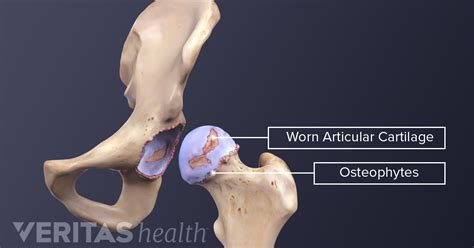 What Is Hip Osteoarthritis?