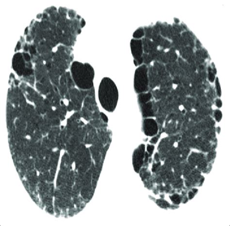 Substantial paraseptal emphysema. Multiple, relatively large cystlike ...