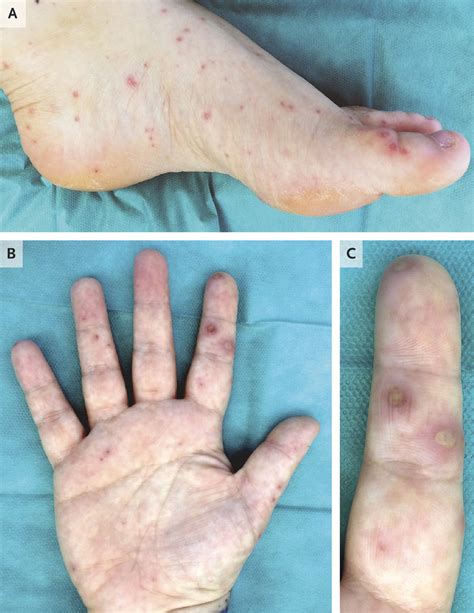 Rare case of Rat Bite Fever reported in NEJM