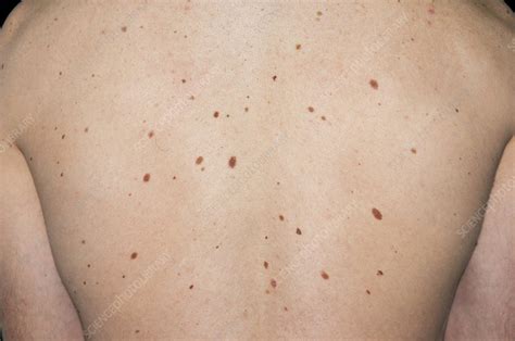 Moles on the skin of the back - Stock Image - C011/7367 - Science Photo ...