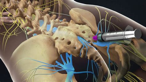 Lumbar caudal epidural steroid injection Southlake, Texas – South Lake Pain Center – Pain ...