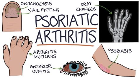 Psoriasis: symptoms, causes, treatment - Chronic Kidney Disease Explained