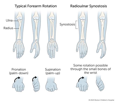 Radioulnar synostosis | Boston Children's Hospital