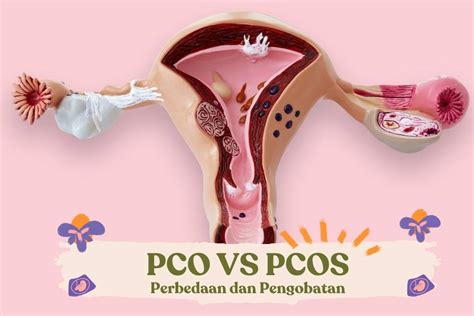 Hampi Mirip, Berikut Perbedaan PCO dan PCOS