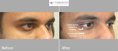 Almond Eye Surgery Before and After Gallery | Taban MD