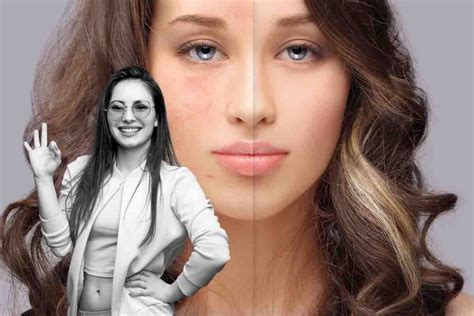 Acne, natural remedies to prevent and treat it - Breaking Latest News