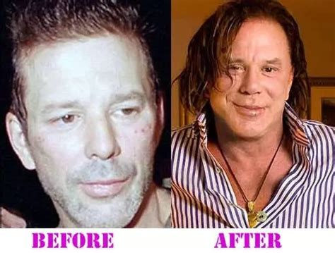 Mickey Rourke Plastic Surgery - With Before And After Photos