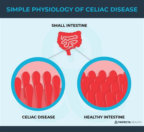 Celiac Disease 101: Symptoms, Causes & Treatment