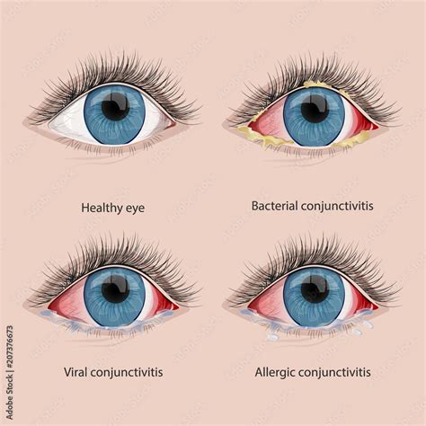 Conjunctivitis types.Eye disease Stock Illustration | Adobe Stock