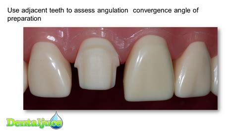 Incisor MC (PFM) Prep | Enhanced Dental CPD Online