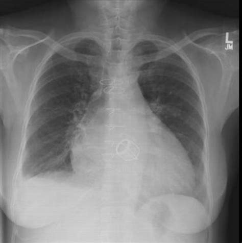 Cardiomegaly chest x ray - wikidoc