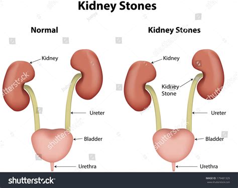 Kidney Stones In The Urinary System Stock Photo 179481329 : Shutterstock