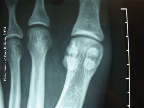 Sesamoid Bone Fracture