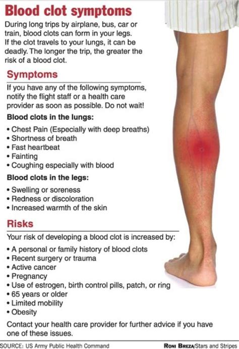 Signs of a Blood Clot - EduardorosChang