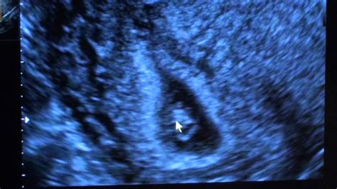 6 Weeks 4 days Ultrasound, twins! - YouTube