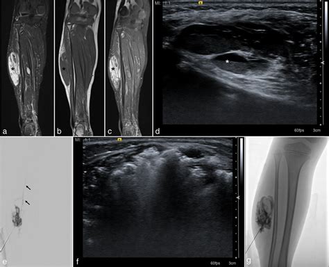 Intramuscular venous malformation in the right leg of a 5-year-old boy.... | Download Scientific ...