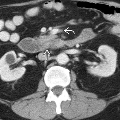 Duodenal Carcinoma | Radiology Key