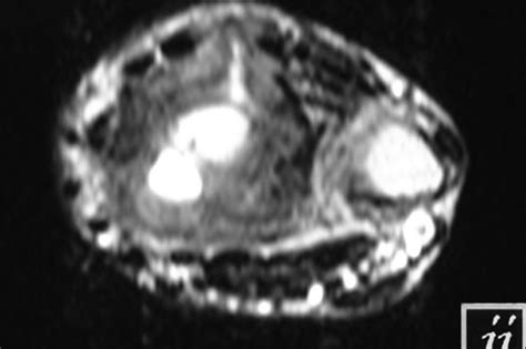 Giant cell tumor – Radiopaedia