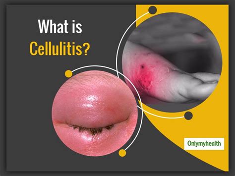 What Is Cellulitis Disease: Causes, Symptoms, Diet And Treatment | OnlyMyHealth