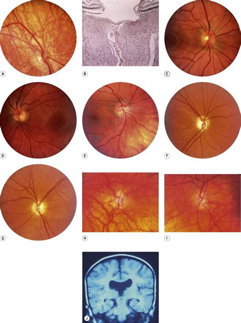 Optic Nerve Diseases that may Masquerade as Macular Diseases | Ento Key