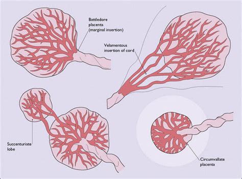 Chorioangioma of Placenta | IntechOpen