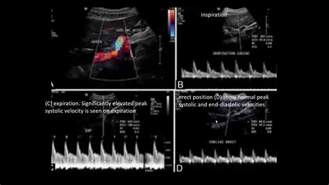 Triplex Ultrasound MEDIAN ARCUATE LIGAMENT SYNDROME Dr Ahmed esawy - YouTube