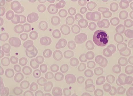 Peripheral blood film of a patient with an iron deficiency anemia. The ...