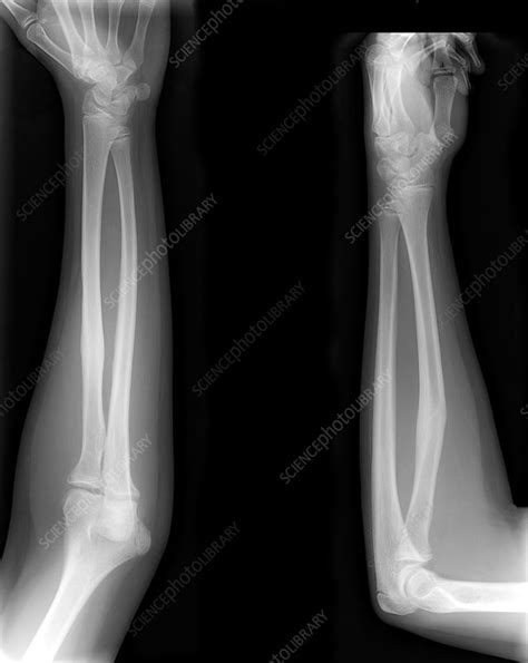 Healed arm bone fracture, X-rays - Stock Image M330/1768 - Science ...