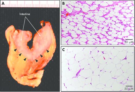 The macroscopical and histological hallmarks of ''creeping fat'' in ...