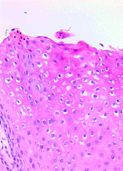 Pathology Outlines - LSIL / CIN I