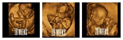 3D 4D- Ultrasound Pictures- Youngstown, Boardman Ohio