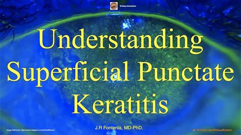 Understanding Superficial Punctate Keratitis. - YouTube