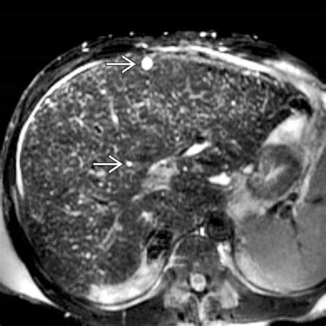 Biliary Hamartoma | Radiology Key