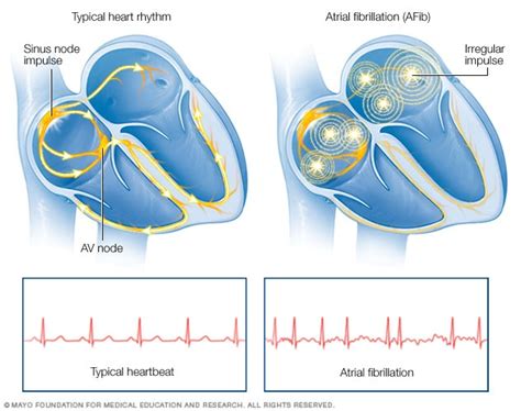 Atrial fibrillation - Symptoms and causes - Mayo Clinic