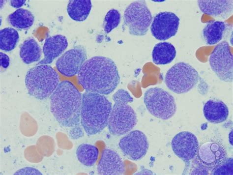 Acute Monoblastic and Monocytic Leukemia - 4.