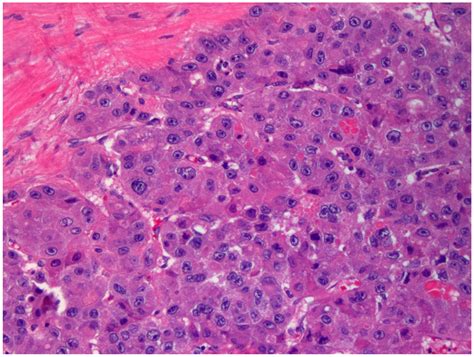 Diagnostics | Free Full-Text | Hepatocellular Carcinoma, Fibrolamellar Variant: Diagnostic ...