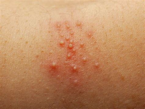 Staph Infection: 10 Staph Infection Symptoms